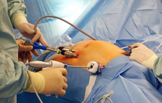 laparoscopic cholecysectomy